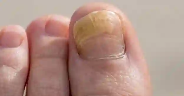 Толстые желтые ногти: 6 средств, которые помогут