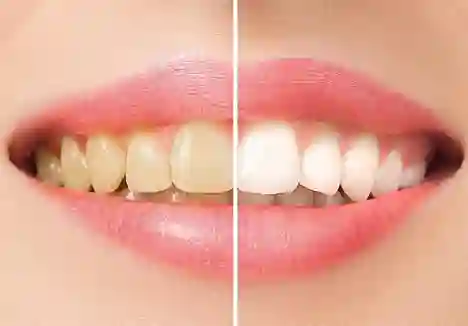 Самостоятельное отбеливание зубов