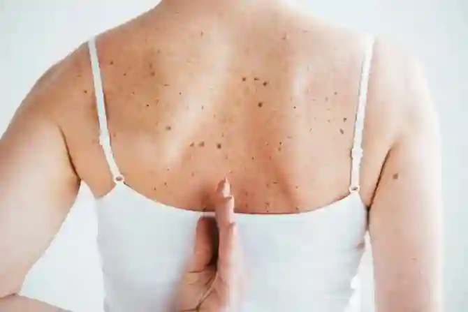 Возрастные пигментные пятна на коже: причины и лечение