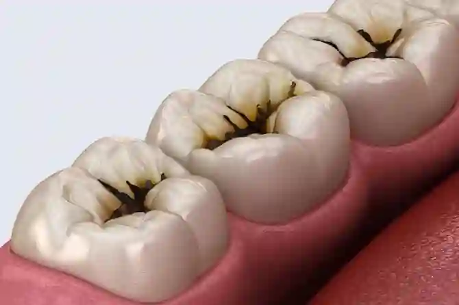 Бактерии, вызывающие кариес зубов
