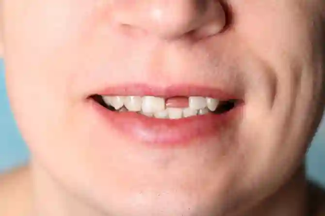 Сломан зуб: что делать?
