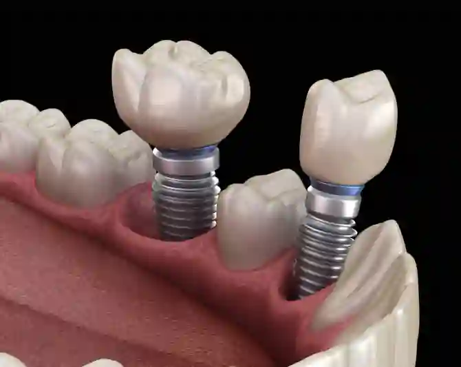 Зубные имплантаты: разновидности, установка и уход
