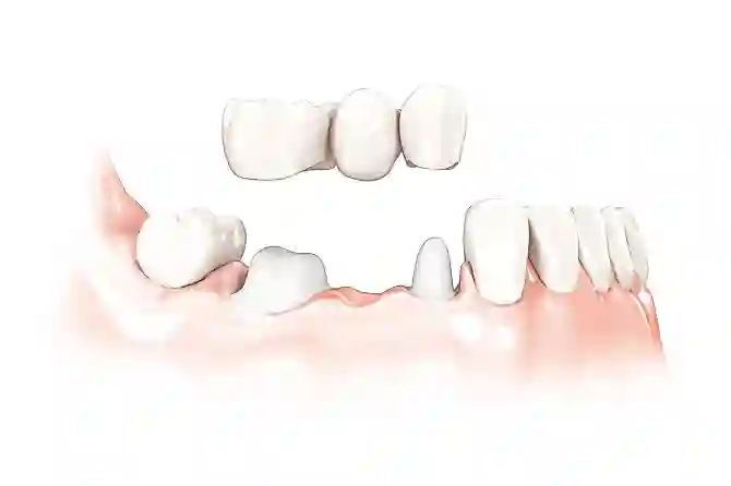 Зубной мост: виды, достоинства и недостатки